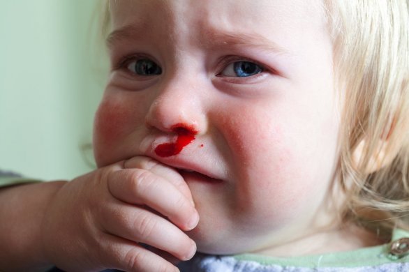 Santé. Mon enfant saigne du nez : que faire ? 